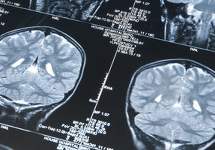 Tumori cervello, un software 'bravo' come i medici nella  diagnosi