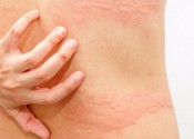 Natural help for hives 